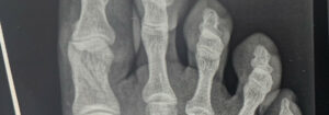 Fracture of my right big toe in several places.