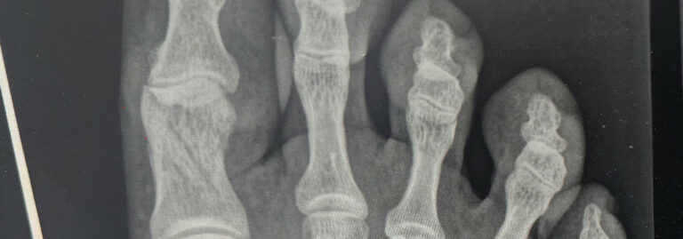 Fracture of my right big toe in several places.