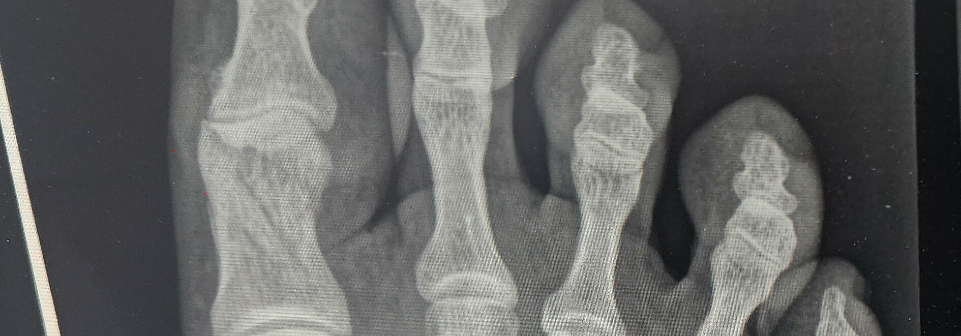 Fracture of my right big toe in several places.