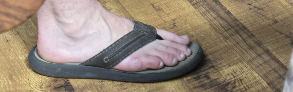 Extreme example of Miata Hot Foot where my foot was burned driving racing the NA Miata.